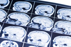 How to Sue for an Old Traumatic Brain Injury that Occurred in Texas